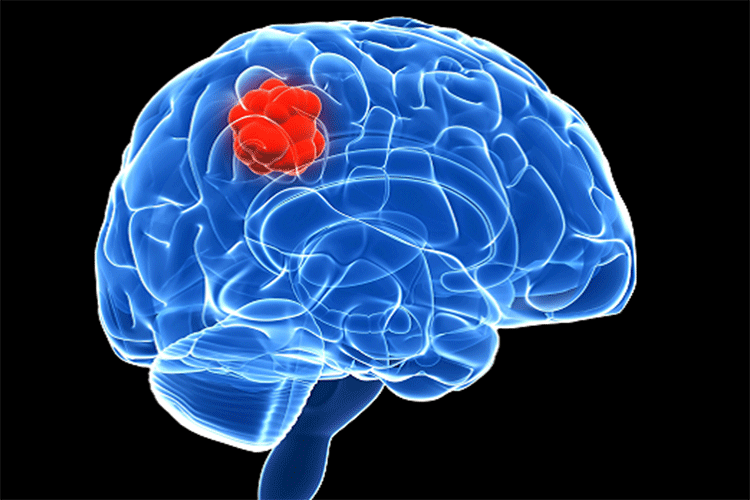 SRT-Στερεοταξία-(SRT-Stereotactic-Radiotherapy-)